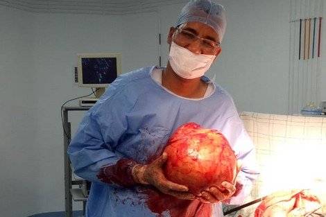 سابقة .. فريق طبي مغربي يستأصل ورم بوزن 8 كيلوغرامات من جسم مريض