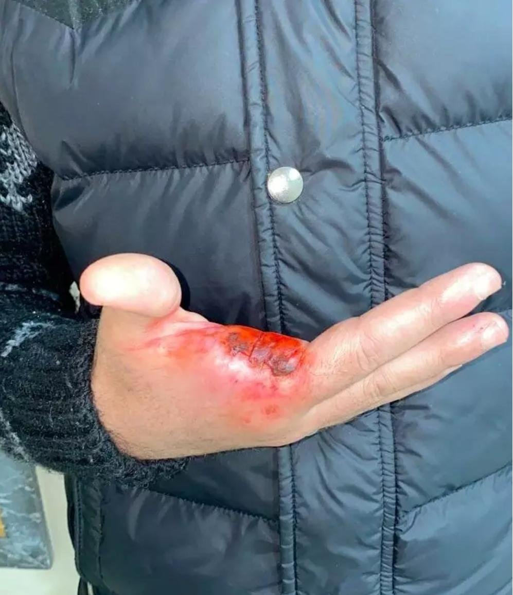 مواطن يتعرض لعملية بتر إصبعه بطنجة على يد ثلاثة أشخاص