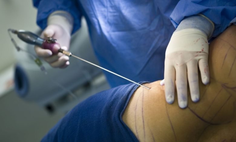 وفاة ”خبيرة تجميل” أثناء إجرائها لعملية شفط للدهون بطنجة