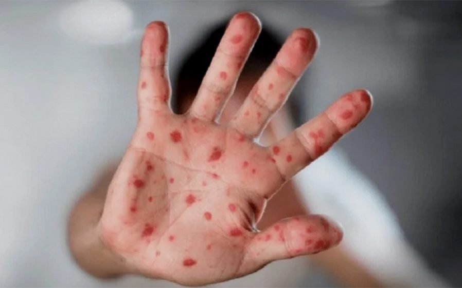 هذه هي المدينة لي لقاو فيها الحالات المشتبه فإصابتها بفيروس “جدري الردة”..التفاصيل