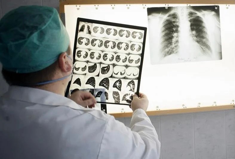 أزيد من 30 ألف إصابة بمرض السل بالمغرب