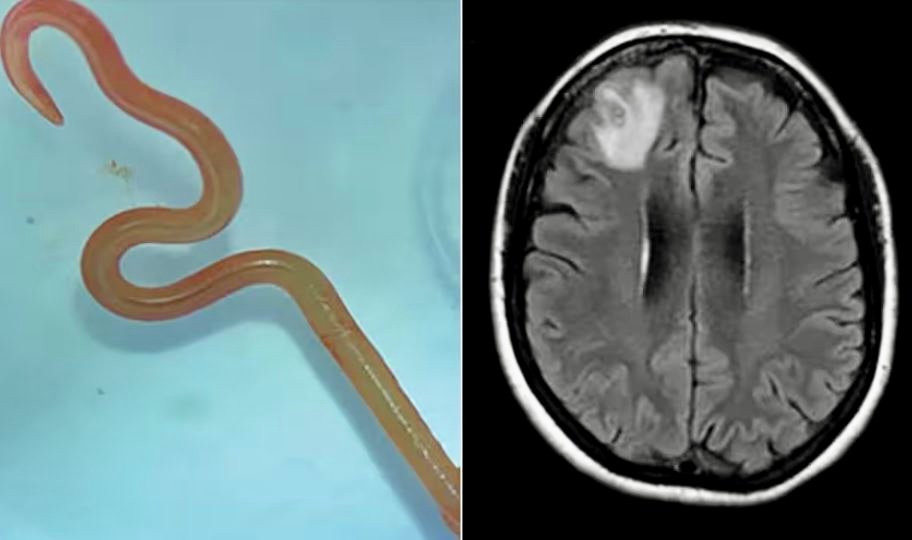 أطباء يرصدون للمرة الأولى “دودة الثعابين” في دماغ أسترالية