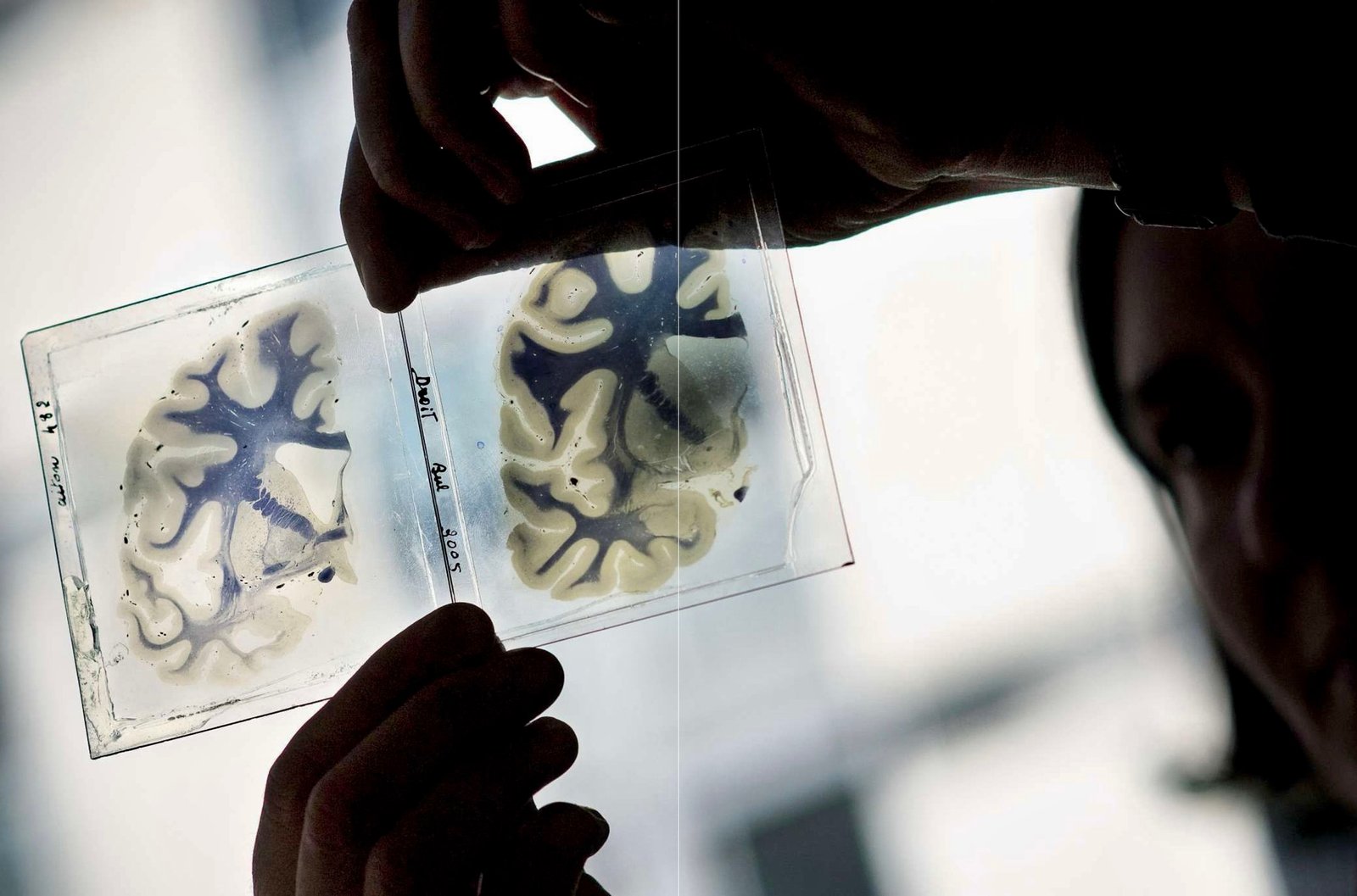 علماء يكتشفون طريقة محتملة لعلاج الزهايمر