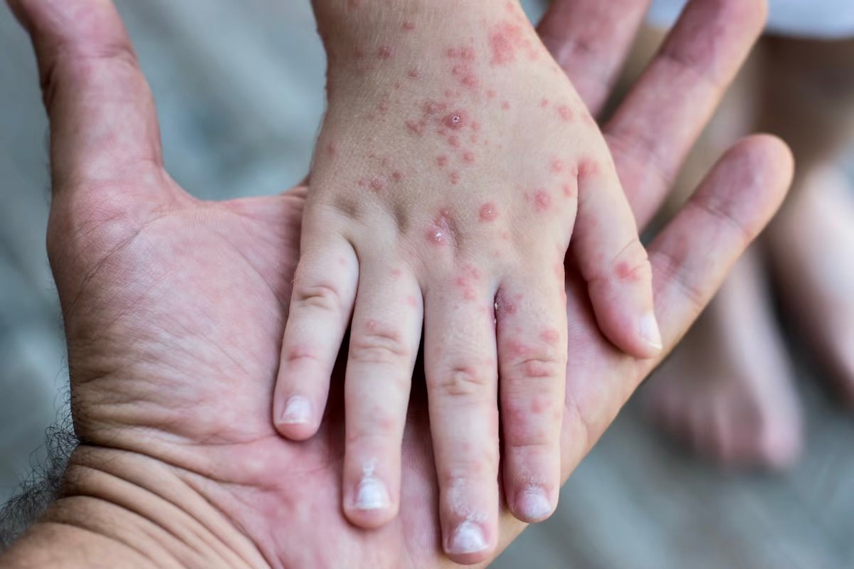 ‎وزارة الصحة تطلق حملة وطنية واسعة لتعزيز التلقيح ضد “بوحمرون”