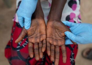 دول إفريقيا الجنوبية تدعو إلى تحرك عاجل لمكافحة جدري القردة