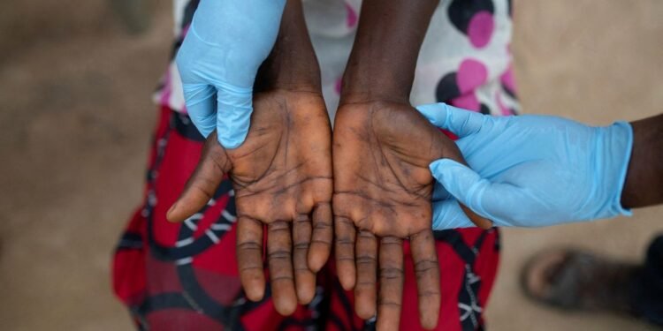 دول إفريقيا الجنوبية تدعو إلى تحرك عاجل لمكافحة جدري القردة