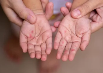 منظمة الصحة تستدعي لجنة طوارئ بشأن انتشار جدري القردة