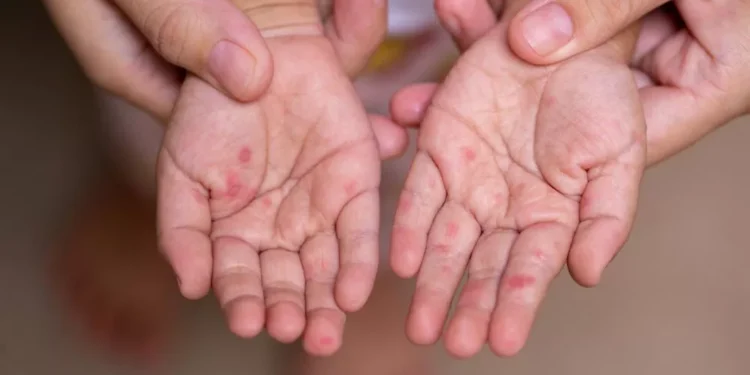 منظمة الصحة تستدعي لجنة طوارئ بشأن انتشار جدري القردة