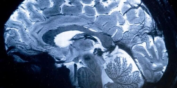 لأول مرة.. باحثون يكتشفون موقع تطور الفصام